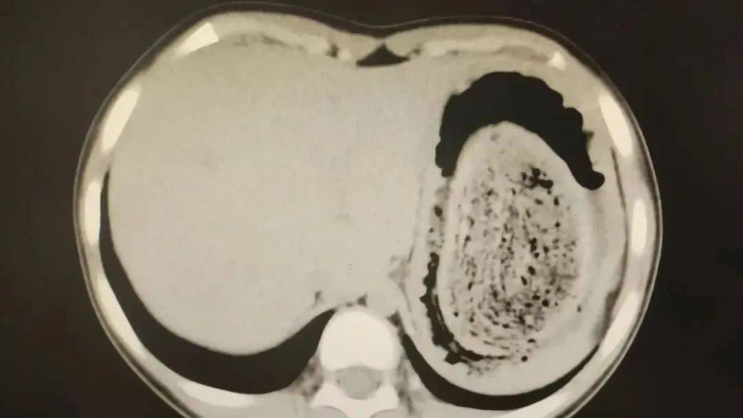 皇冠信用网登2_发现1例皇冠信用网登2，15岁女孩确诊！